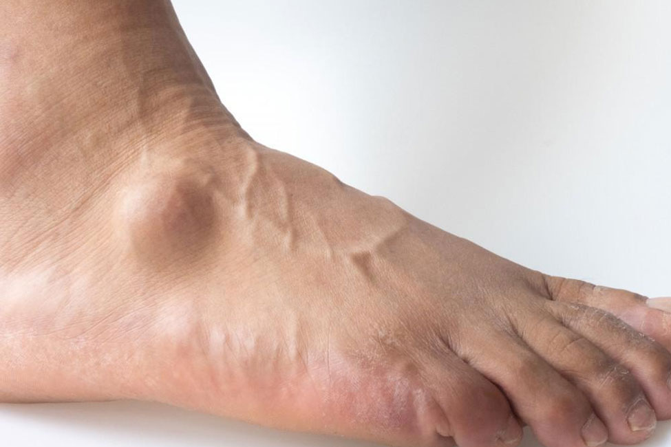 Foot & Ankle Ganglion